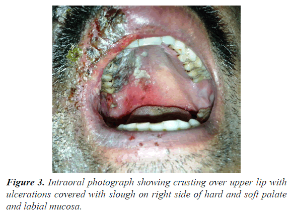 oral-medicine-toxicology-labial-mucosa