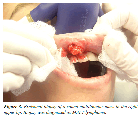 oral-medicine-toxicology-multilobular-mass