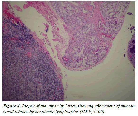 oral-medicine-toxicology-neoplastic-lymphocytes