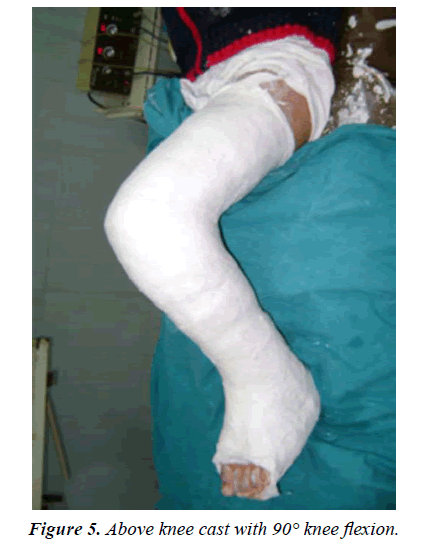 orthopedic-surgery-rehabilitation-Above-knee-cast