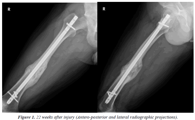 orthopedic-surgery-rehabilitation-Antero-posterior