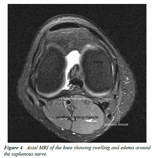 orthopedic-surgery-rehabilitation-Axial-MRI-knee-showing-swelling