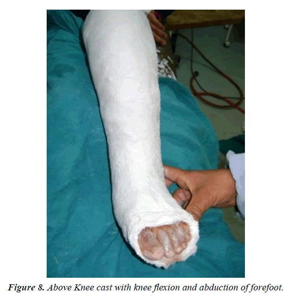 orthopedic-surgery-rehabilitation-abduction-forefoot