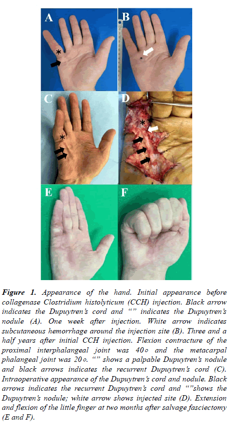 orthopedic-surgery-rehabilitation-indicates-subcutaneous-hemorrhage