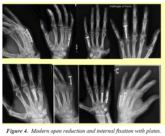 orthopedic-surgery-rehabilitation-internal-fixation-plates