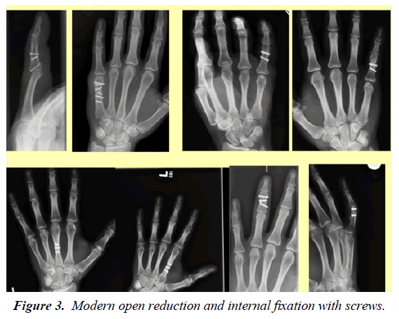 orthopedic-surgery-rehabilitation-internal-fixation-screws