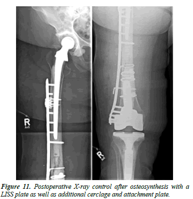 orthopedic-surgery-rehabilitation-segmentary-cerclage