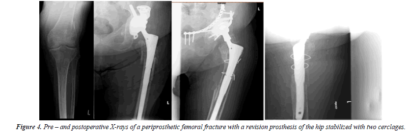 orthopedic-surgery-rehabilitation-segmentary-femoral