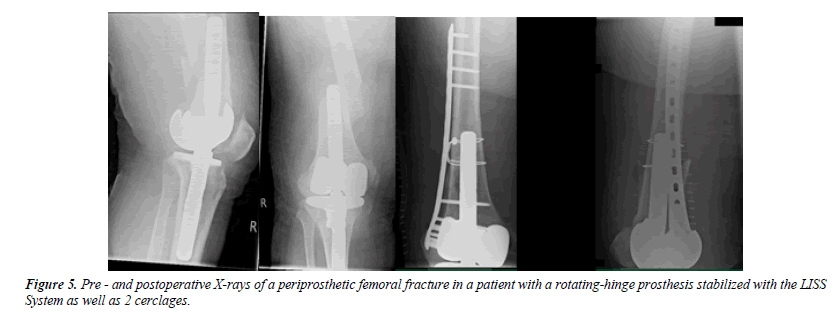 orthopedic-surgery-rehabilitation-segmentary-fracture
