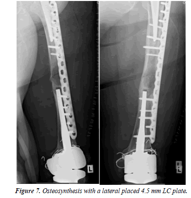 orthopedic-surgery-rehabilitation-segmentary-osteosynthesis