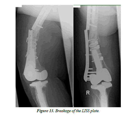 orthopedic-surgery-rehabilitation-segmentary-plate