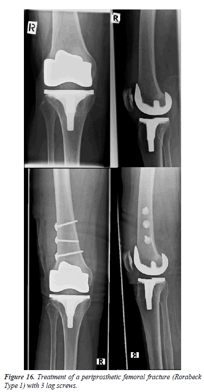 orthopedic-surgery-rehabilitation-segmentary-screws