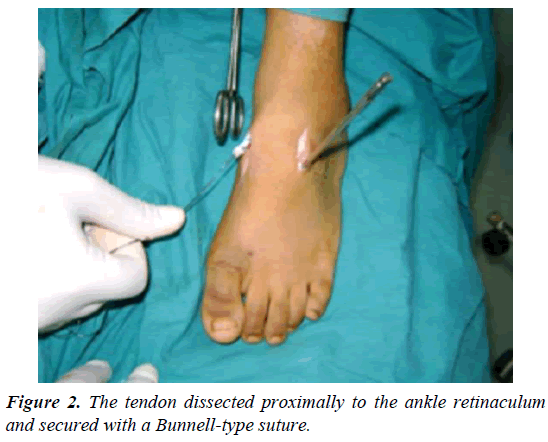 orthopedic-surgery-rehabilitation-tendon-dissected