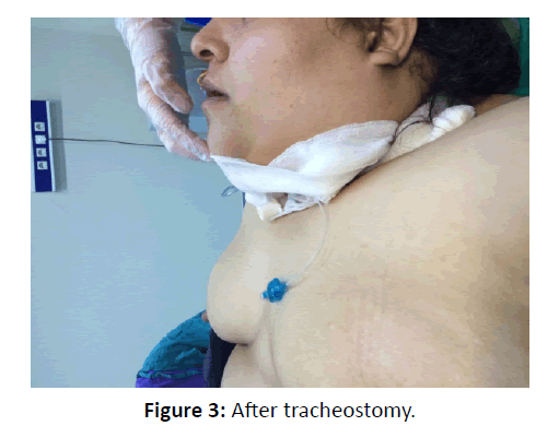 otolaryngology-online-journal-After-tracheostomy