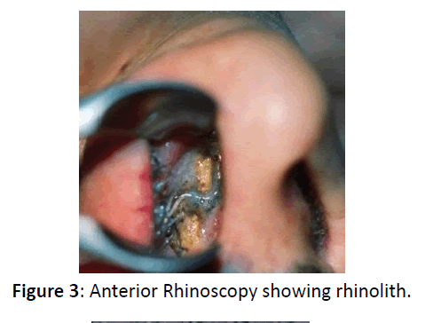 otolaryngology-online-journal-Anterior-Rhinoscopy-rhinolith