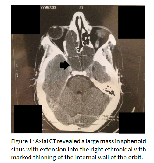 otolaryngology-online-journal-Axial-CT