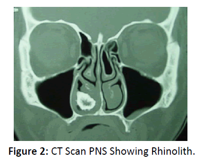 otolaryngology-online-journal-CT-Scan-PNS