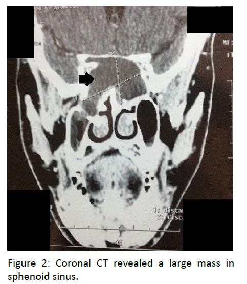 otolaryngology-online-journal-Coronal-CT