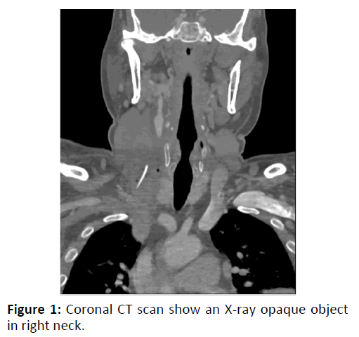 otolaryngology-online-journal-Coronal-CT-scan