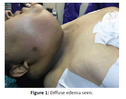 otolaryngology-online-journal-Diffuse-edema-seen