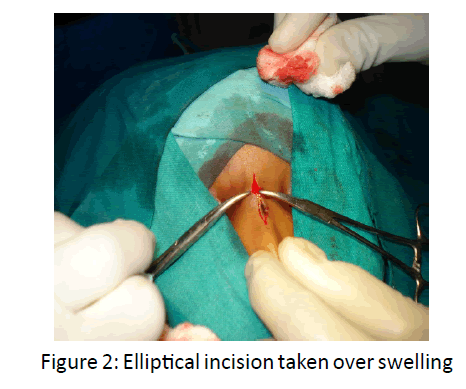 otolaryngology-online-journal-Elliptical-incision