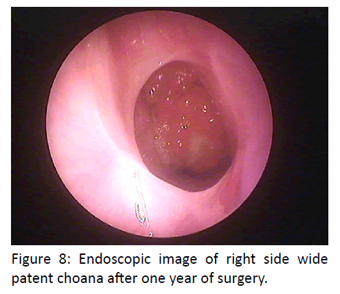 otolaryngology-online-journal-Endoscopic-image