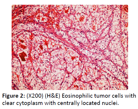otolaryngology-online-journal-Eosinophilic-tumor-cells