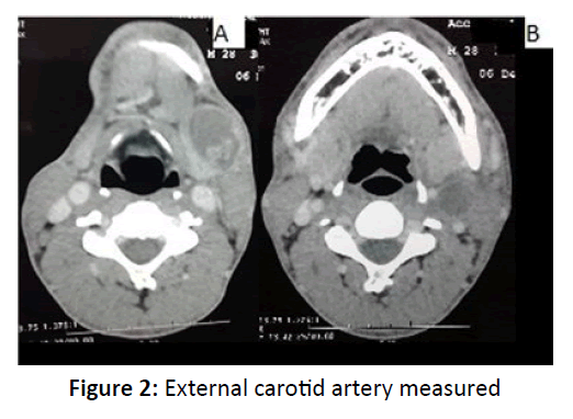 otolaryngology-online-journal-External-carotid