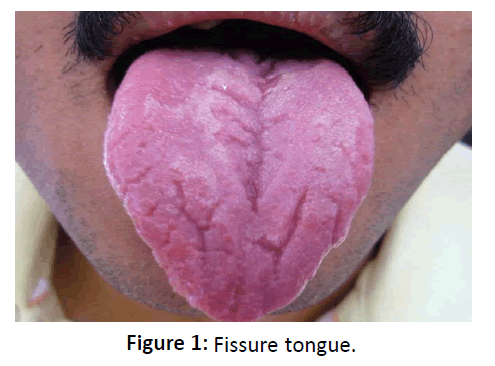 otolaryngology-online-journal-Fissure-tongue