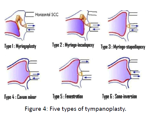 otolaryngology-online-journal-Five-types-tympanoplasty
