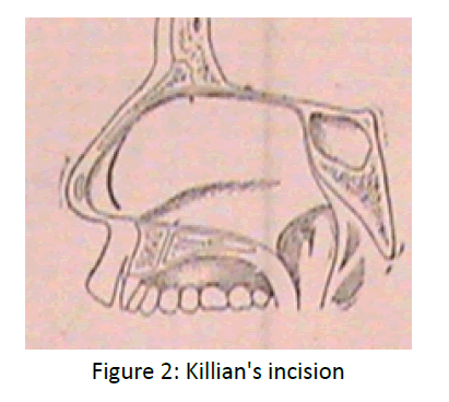 otolaryngology-online-journal-Killian-incision