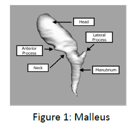 otolaryngology-online-journal-Malleus