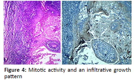 otolaryngology-online-journal-Mitotic-activity
