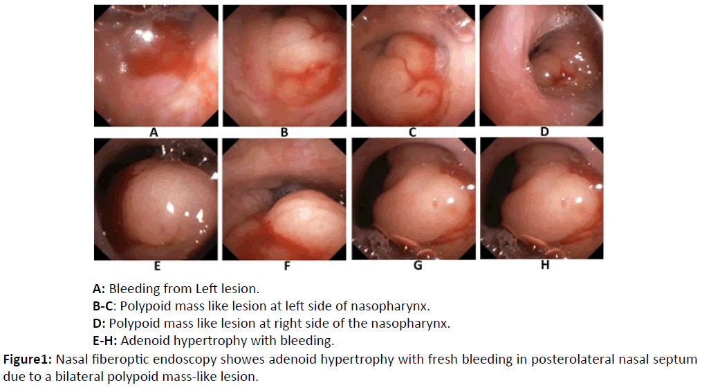 otolaryngology-online-journal-Nasal-fiberoptic-endoscopy