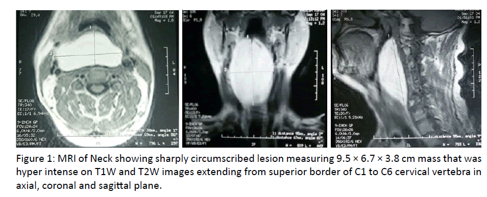 otolaryngology-online-journal-Neck-showing