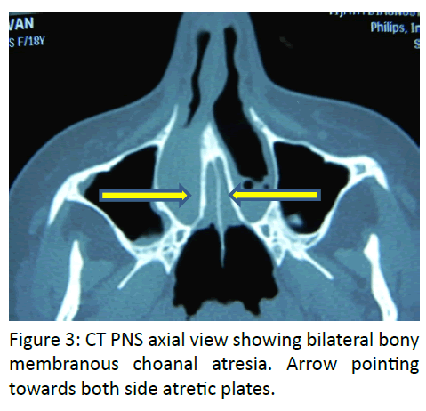 otolaryngology-online-journal-PNS-axial-view