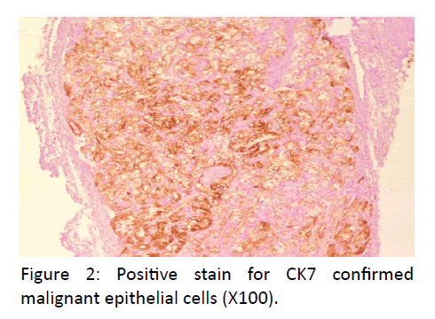 otolaryngology-online-journal-Positive-stain