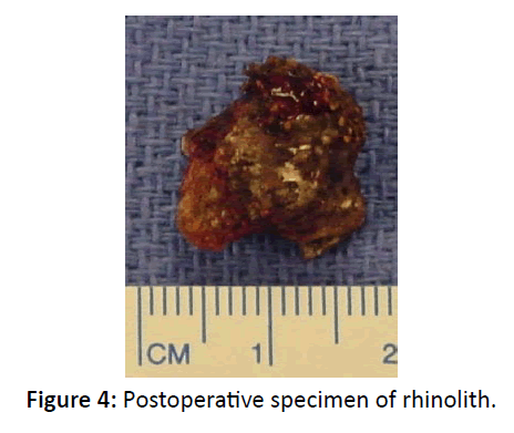 otolaryngology-online-journal-Postoperative-specimen