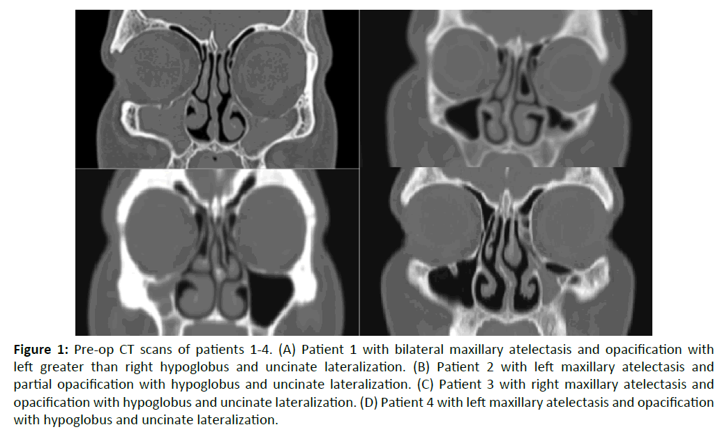 otolaryngology-online-journal-Pre-op-CT-scans