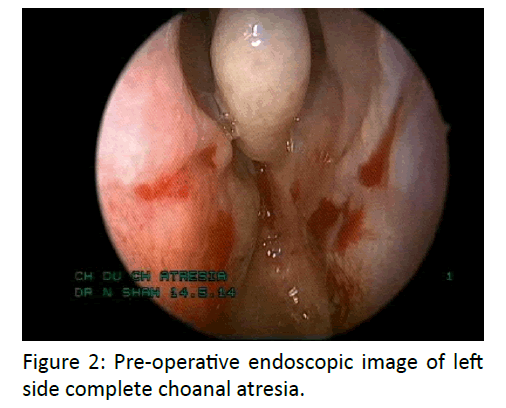 otolaryngology-online-journal-Pre-operative-endoscopic-image