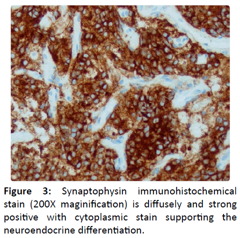 otolaryngology-online-journal-Synaptophysin-immunohistochemical