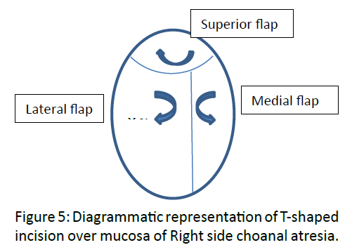 otolaryngology-online-journal-T-shaped-incision