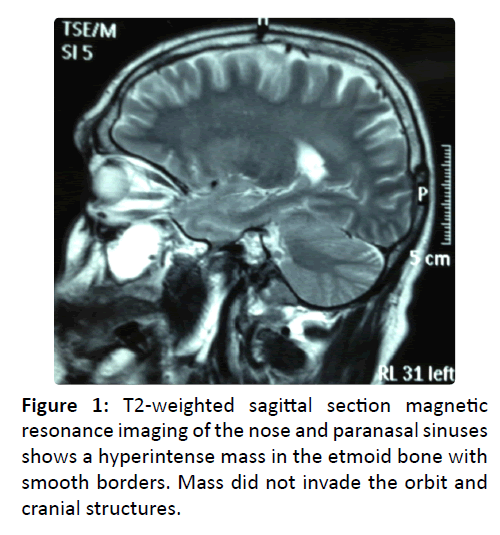 otolaryngology-online-journal-T2-weighted-sagittal-section