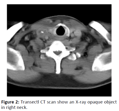 otolaryngology-online-journal-Transectl-CT-scan