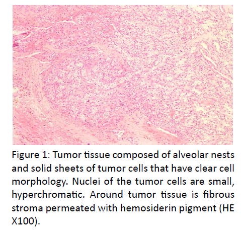 otolaryngology-online-journal-Tumor-tissuel