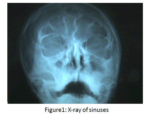 otolaryngology-online-journal-X-ray-sinuses