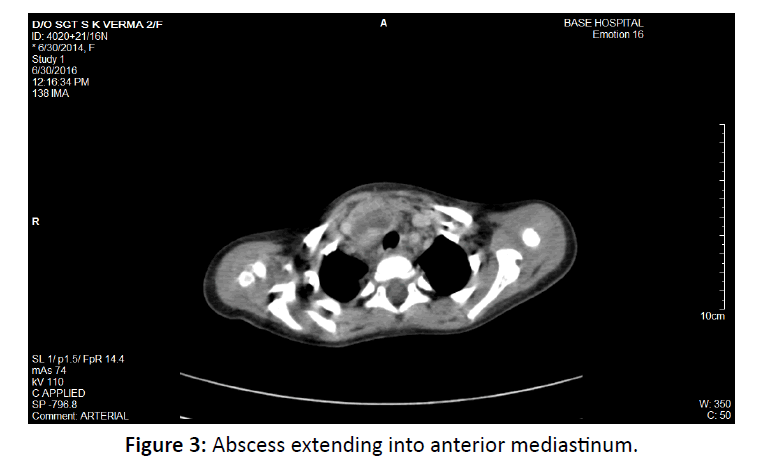 otolaryngology-online-journal-anterior-mediastinum