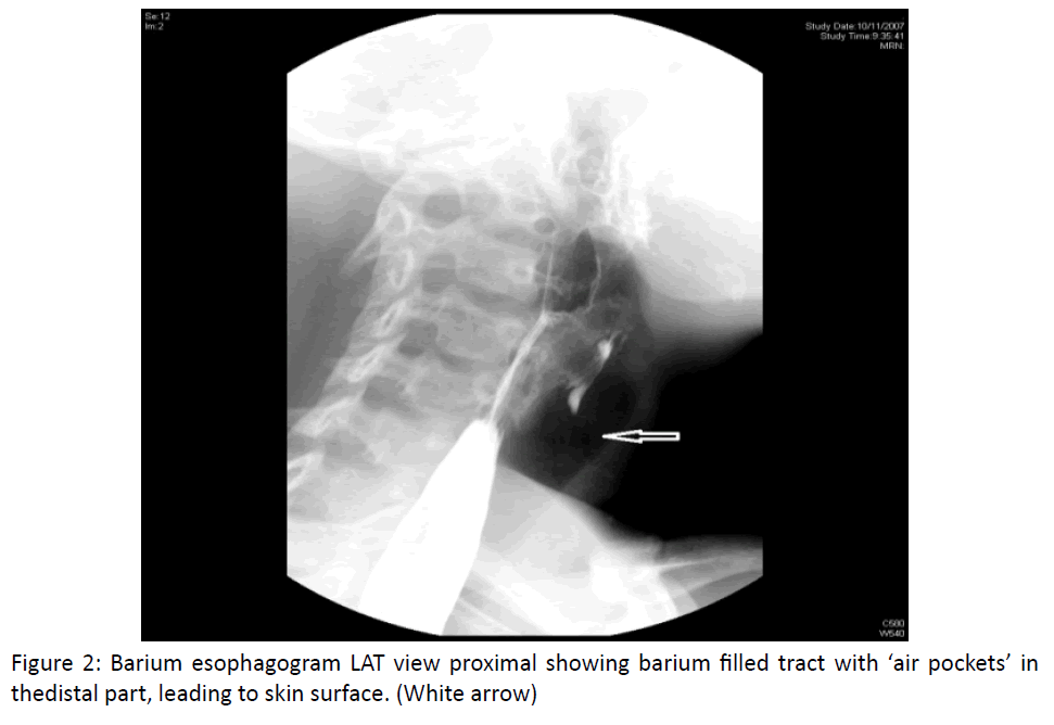 otolaryngology-online-journal-barium-filled