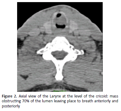 otolaryngology-online-journal-cricoid