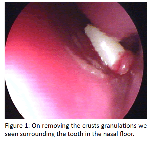 otolaryngology-online-journal-crusts-granulations